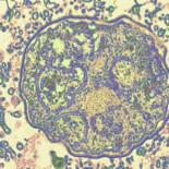 El curioso caso del hombre que venció al VIH