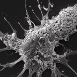 Un análisis de sangre podría ayudar a diagnosticar un agresivo tumor cerebral