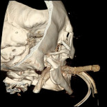 "El paciente no llevaba casco"