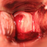 Diario fotográfico del cérvix uterino durante un ciclo menstrual [NSFW]