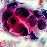 Cáncer: una enzima es la clave para frenar la metástasis