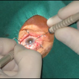 El "milagro" de volver a ver