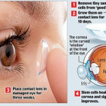 Lentillas con células madre que curan la ceguera