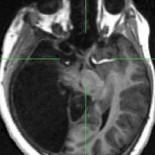 Niña nacida con medio cerebro es capaz de ver completamente con un solo ojo [ENG]