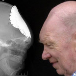 El hombre al que le creció un cráneo nuevo [EN]