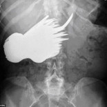 Radiografía de la mujer que se comió una cubertería (eng)