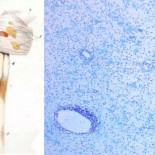 [ENG] Doctor italiano ha podido encontrar una cura para la esclerosis múltiple