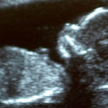 Aumentan las acusaciones de asesinato en EEUU a las mujeres con embarazos fallidos [ENG]