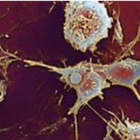 Relacionan una deficiencia genética de vitamina D con la esclerosis múltiple