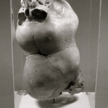 Craniopagus parasiticus