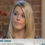 El extraño caso de la joven británica con dos vaginas