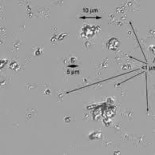 La enfermedad que mató a Baruch Spinoza