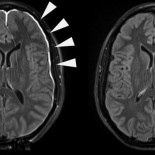 Así se recupera tu cerebro tras un golpe en la cabeza