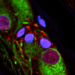 La extirpación del apéndice está vinculada a un menor riesgo de Parkinson (ENG)