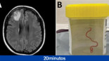 Extraen un gusano vivo de 8 centímetros del cerebro de una mujer