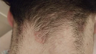 La tiña se expande en Catalunya entre los adolescentes que se rasuran asiduamente la nuca en las barberías 'low cost'