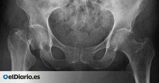 Toneladas de radiografías del Archivo del Hospital Valdecilla fueron recicladas en Alemania y la plata obtenida se la quedó el gestor privado