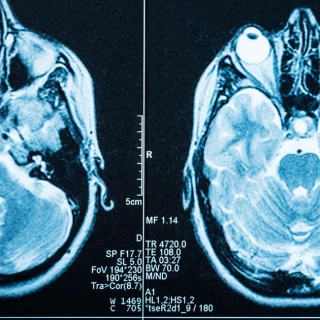 Una máquina de resonancia magnética más barata: una idea para mejorar el acceso a este instrumento diagnóstico