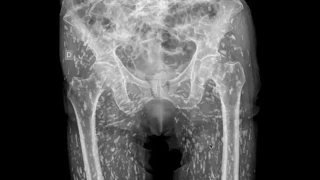 La aterradora radiografía de un hombre con una infección de parásitos alimentarios: "Están por todas partes"