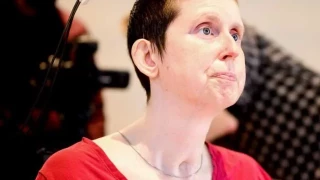 Una mujer recupera el habla 18 años después de un ictus gracias a una prótesis cerebral de inteligencia artificial