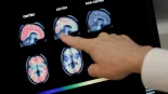 Un panel de 21 expertos revisa 80 fármacos y señala tres candidatos contra el alzheimer: Viagra, vacuna del herpes zóster y riluzol