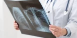 Millones de personas tienen la bacteria que causa la tuberculosis sin saberlo