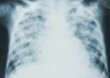 Los casos de tuberculosis han aumentado un 10 % en España