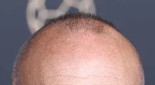 La calva que necesita crema SPF 2 millones