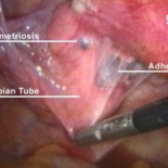 Riesgos de una cesárea para la madre