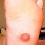 Le sale un pezón en la planta del pie [ENG]