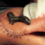 Un hospital de Tarragona utiliza sanguijuelas en trasplantes de piel