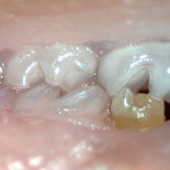 Generado un diente a partir de células madre