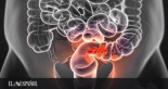 Golpe español al cáncer de colon: la sencilla prueba para detectarlo con años de antelación