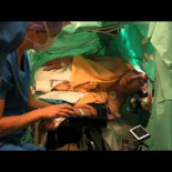 Craneotomía a un cantante