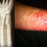 Menor con un brazo roto por un golpe de porra de los antidisturbios [CAT]