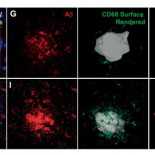 Consiguen eliminar las placas del alzhéimer con ultrasonidos